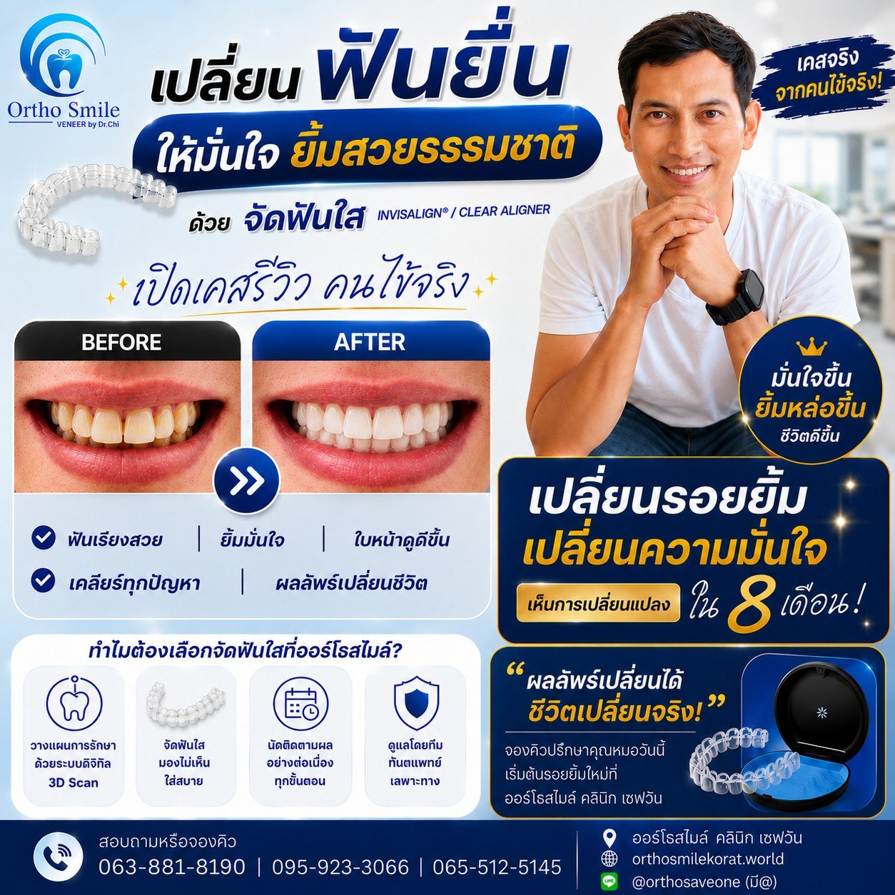 เปลี่ยนฟันยื่นให้ยิ้มสวยธรรมชาติด้วยจัดฟันใส