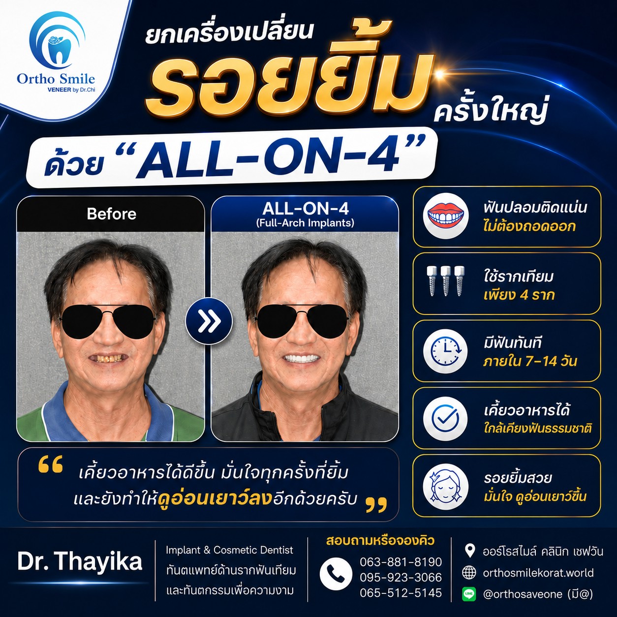 ยกเครื่องเปลี่ยนรอยยิ้มครั้งใหญ่ด้วย All-on-4