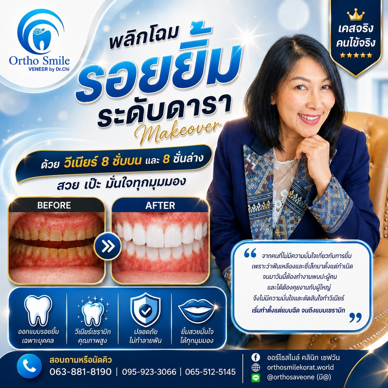พลิกโฉมรอยยิ้มระดับดารา ด้วยวีเนียร์ 8 ซี่บน 8 ซี่ล่าง